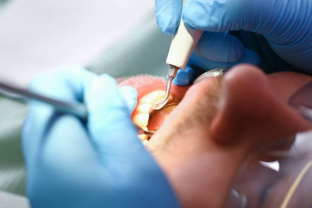 Best Emergency Dental Extractions in Wyong, MI